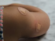 台父生蛇致未滿1歲女生水痘！母3天後同染水痘｜即睇4個水痘病徵