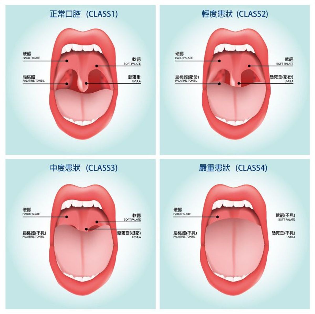 健康生活, 鼻鼾, 鼻塞, 鼾症