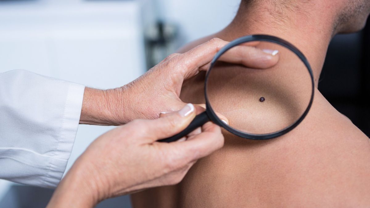 理財方法｜「痣」會決定財富、運勢、反映人體健康狀態？揭示痣背後的奧秘
